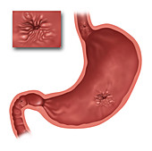 Stomach Ulcers,Illustration