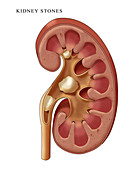 Kidney Stones,Illustration
