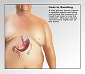 Gastric Banding,Illustration