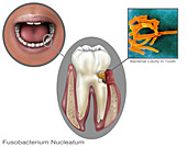 Oral Infection,Illustration