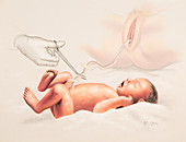 Cutting Cord,Childbirth,Illustration
