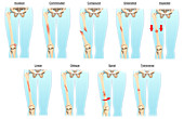 Types of Bone Fractures,Illustration