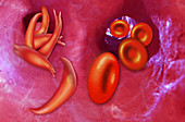 Sickle Cells,Illustration