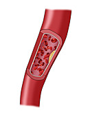 Clogged Artery,2 of 5,Illustration