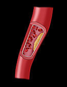 Clogged Artery,3 of 5,Illustration