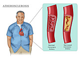 Man with Heart Disease,Illustration
