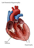 Left Ventricle Hypertrophy,Illustration