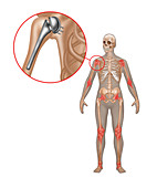 Shoulder Joint Replacement,Illustration