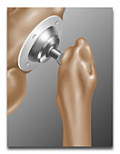Hip Joint Replacement,Illustration