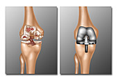 Knee Joint Replacement,Illustration