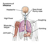 Symptoms of Influenza,Illustration