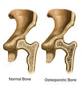 Osteoporotic & Normal Bone,Illustration