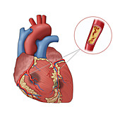 Clogged Artery,Illustration