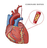 Coronary Bypass,Illustration
