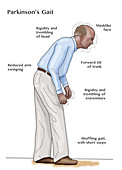 Man with Parkinson's,Illustration