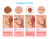 Lumpectomy,Illustration