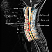 Cervical Spine Injury,MRI,Illustration