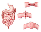 Strictureplasty,Illustration