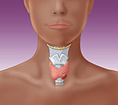 Thyroid Cancer,Illustration