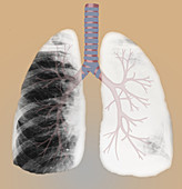 Bronchus Cancer,illustration
