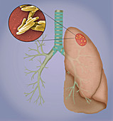 Tuberculosis and granulomas,illustration