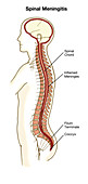 Spinal Meningitis,illustration