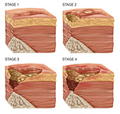 4 Stages of a Bedsore,Illustration