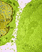 KB Cell Infected with Adenovirus (TEM)