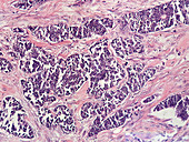 Ductal Breast Carcinoma,LM