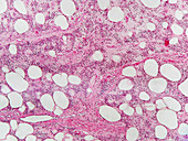 Spindle Cell Lipoma,LM
