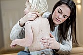 Mother treating daughter with chickenpox