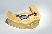 Dental cast with abutments and bar