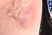 Armpit abscess