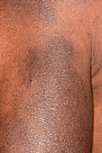 Post-inflammatory pigmentation in eczema