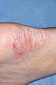 Acute eczema