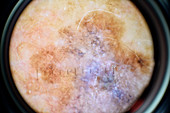 Melanoma skin cancer,dermatoscope image