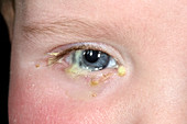 Conjunctivitis