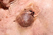 Haematoma following pacemaker surgery