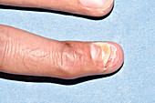 Broken finger