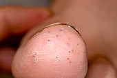 Sea urchin spines in big toe