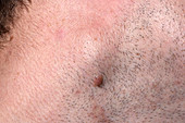 Swollen lymph node