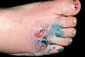 Cutaneous leishmaniasis lesions