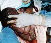 Caesarian section