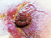 Enterocutaneous fistula
