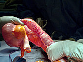 Megacolon resection in ischaemic colitis