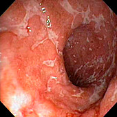 Ulcerative colitis in the rectum