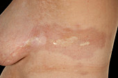 Morphea