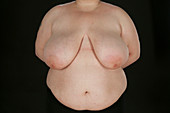 Breast hypertrophy