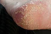 Psoriasis