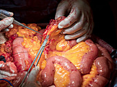 Small intestine resection surgery
